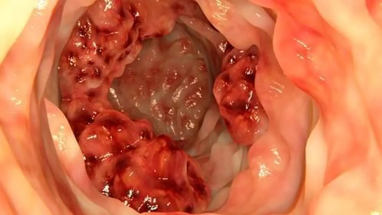 العلاج المناعي الكيميائي ينجح في تقليص احتمالات انتكاس مرض سرطان القولون